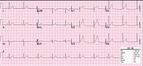 moderate high lateral repolarization disturbance